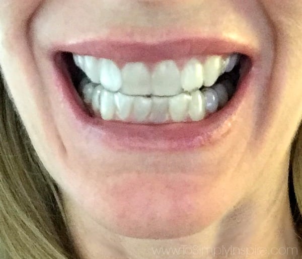 A close up of a persons mouth smiling wearing invisible aligners on teeth