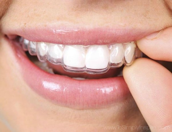 A close up of a woman mouth wearing invisible aligners