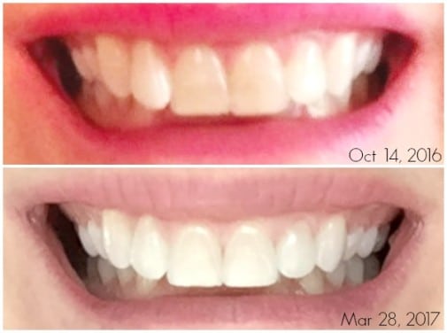 comparison of smile after using invisible aligners 