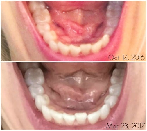 comparison of bottom teeth after using invisible aligners 