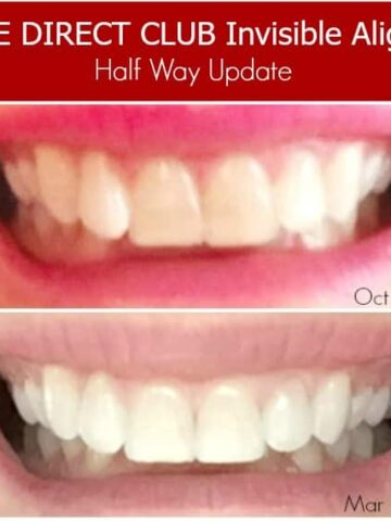 comparison of smile after using invisible aligners