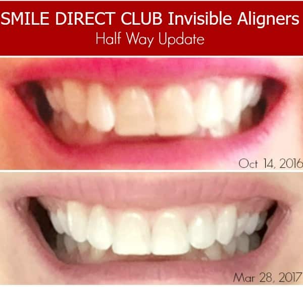 comparison of smile after using invisible aligners 