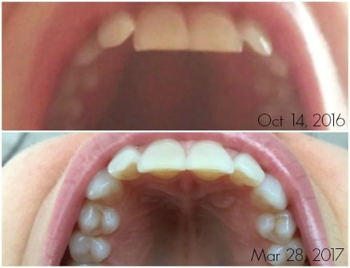 comparison of top teeth after using invisible aligners 